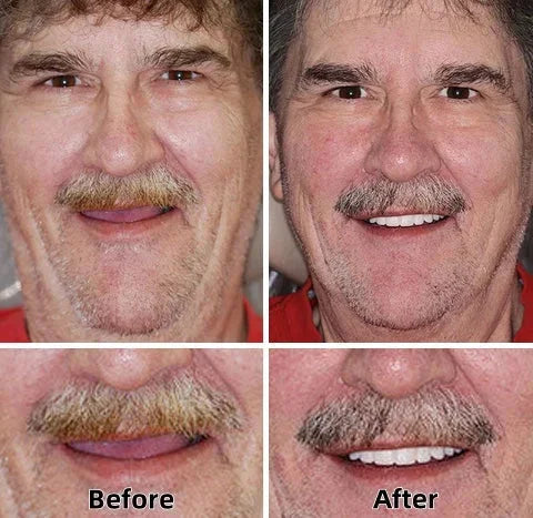 Medazy™-Advanced Custom-Fit Functional Dentures 😁 Smile with Confidence