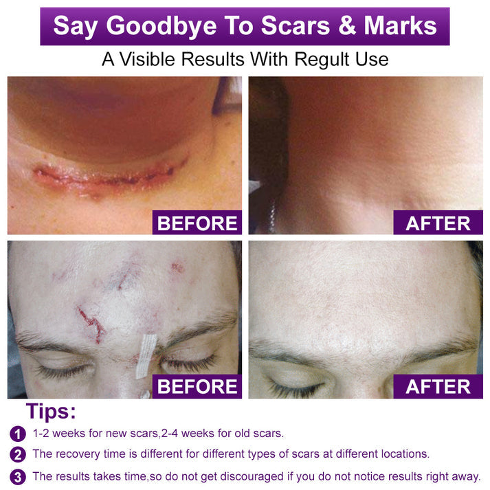 ššUKCA-CERTIFIED ā
AQA⢠cure FACE & BODY SCAR GEL ā Clinically proven to soften, flatten and fade surgical scars, acne marks, burns, keloids and trauma-related scars.