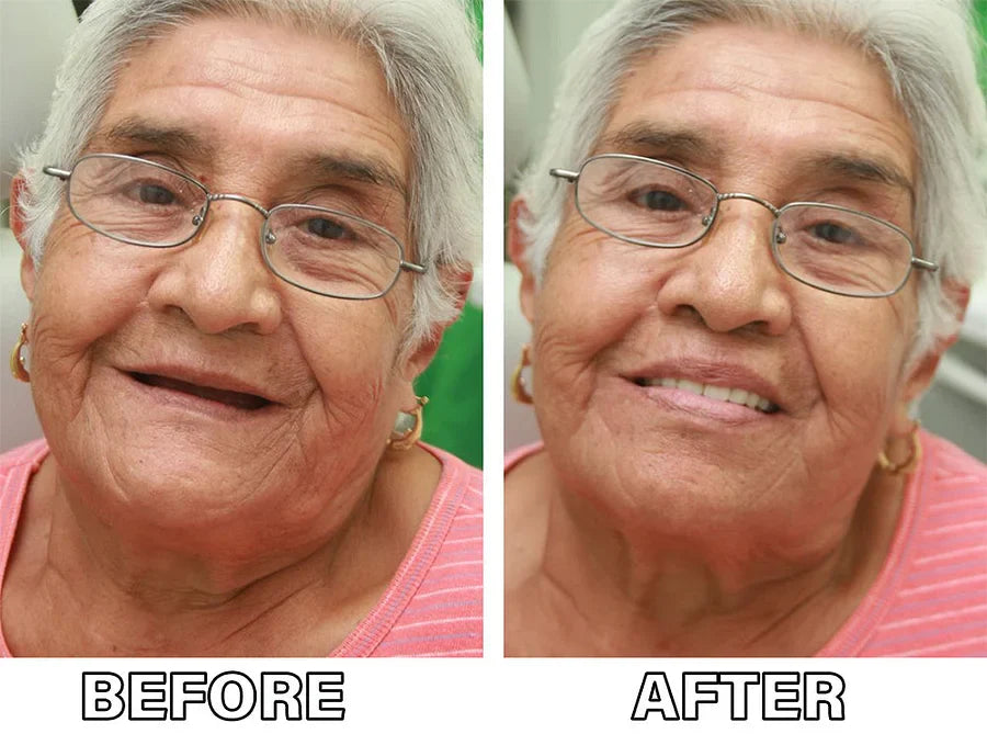 Medazy™-Advanced Custom-Fit Functional Dentures 😁 Smile with Confidence